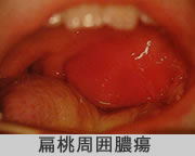 扁桃周囲膿瘍の写真