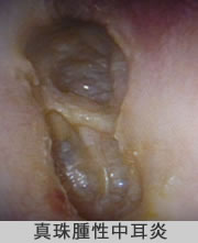 真珠腫性中耳炎の写真