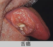 舌癌の写真