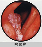 喉頭癌の写真